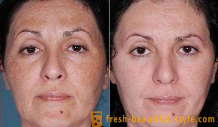 Киселинни пилинг за лице: отзиви, снимки преди и след