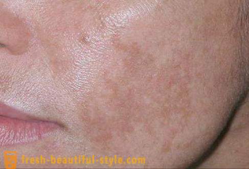 Кафяви петна по лицето: на причините и лечения. кафяви петна