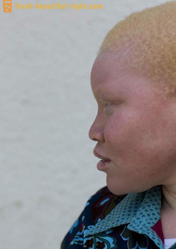 Трагичната история на Танзания албиноси