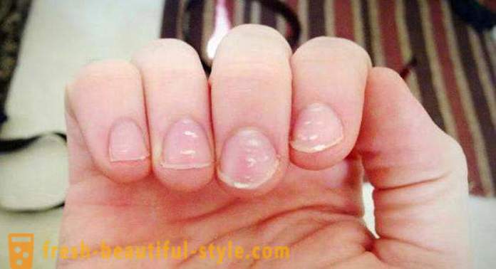 Бели петна по ноктите на пръстите на ръцете: на причините и лечението